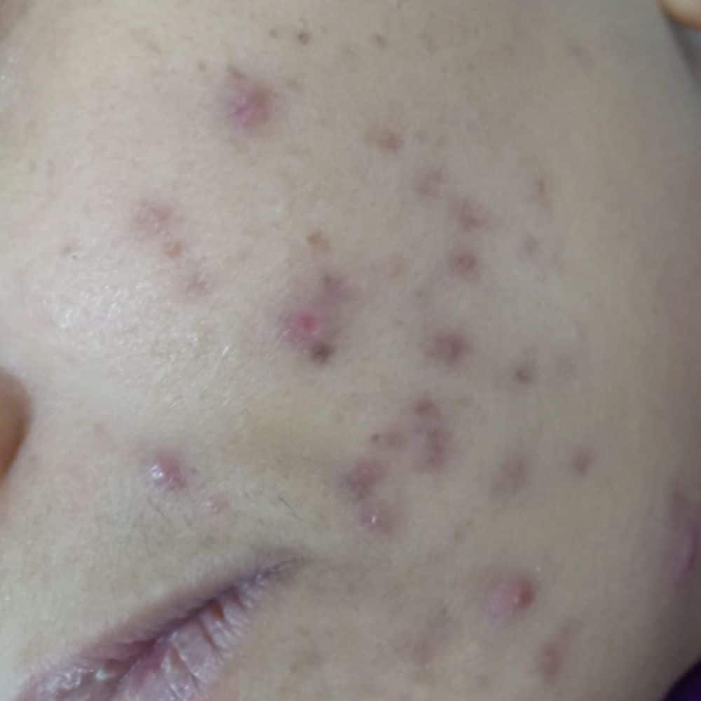 أنواع حب الشباب